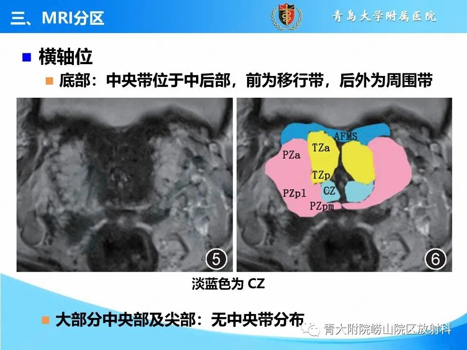 影像PPT - 【PPT】前列腺MRI解剖分区-15