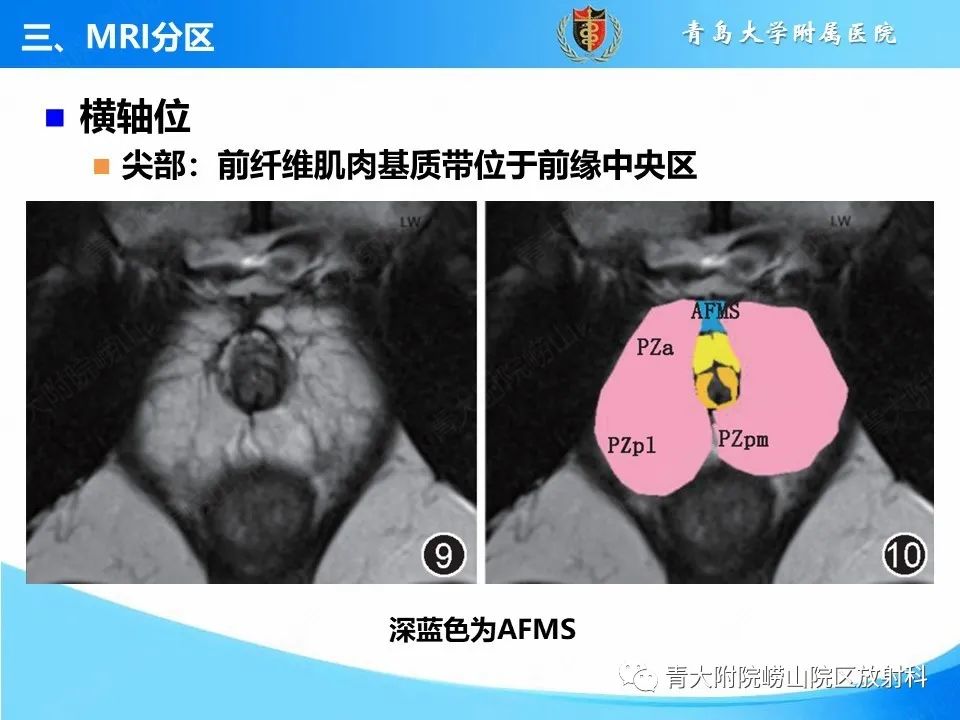 影像PPT - 【PPT】前列腺MRI解剖分区-25