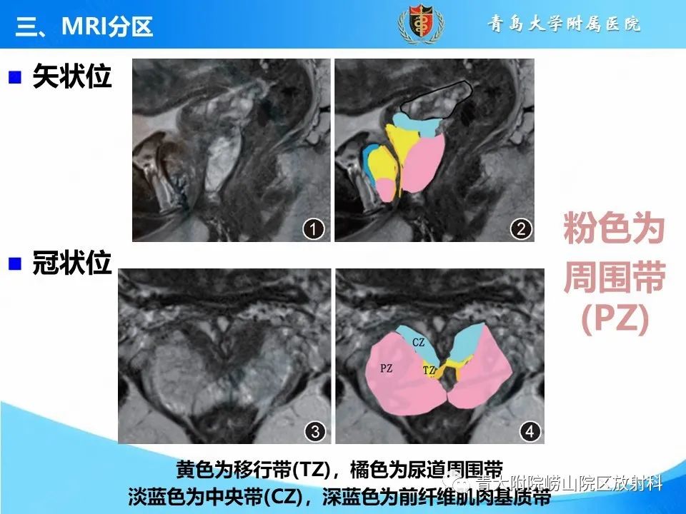 影像PPT - 【PPT】前列腺MRI解剖分区-17