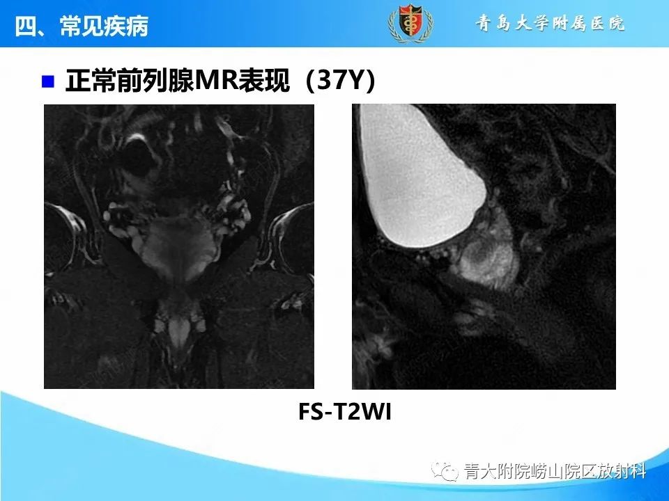 影像PPT - 【PPT】前列腺MRI解剖分区-27