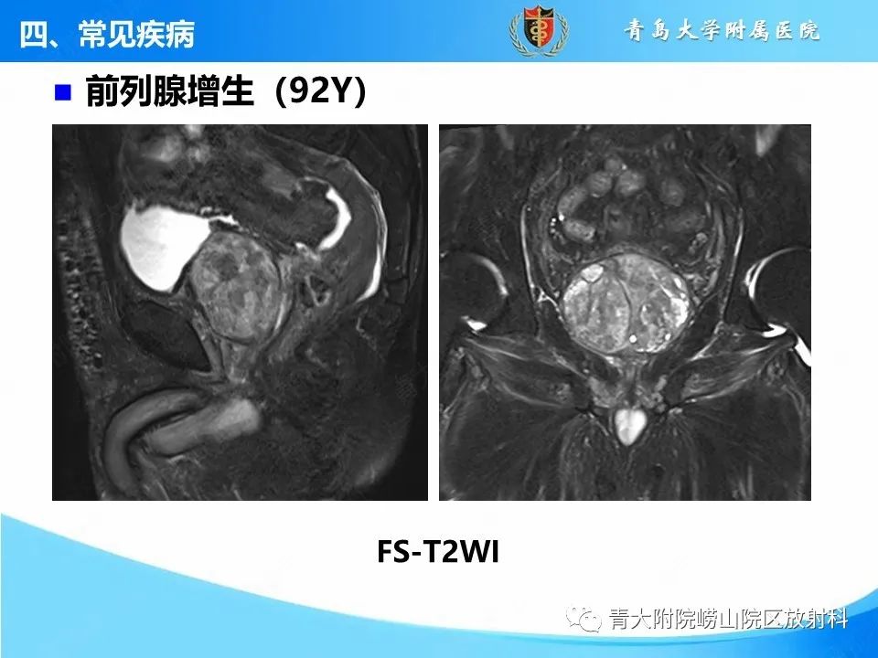 影像PPT - 【PPT】前列腺MRI解剖分区-31