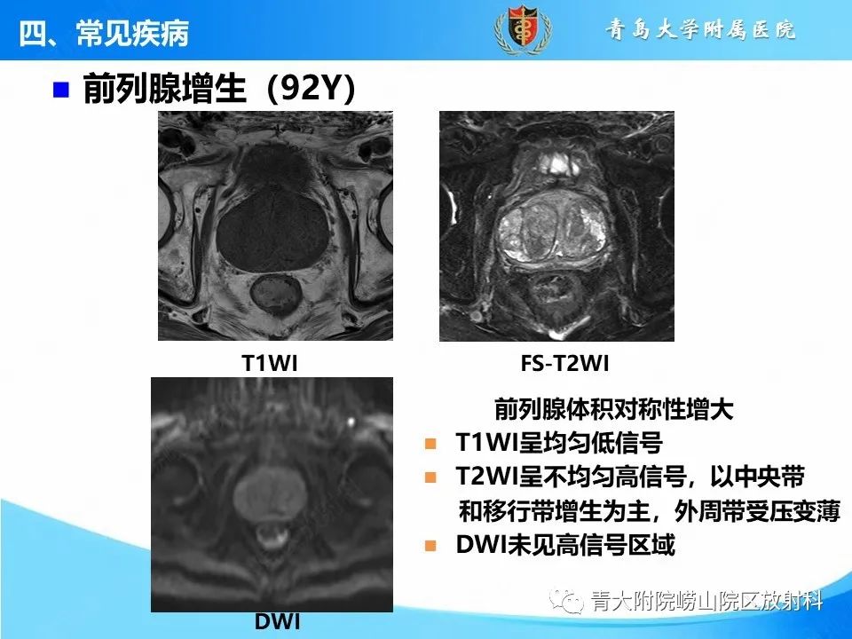 影像PPT - 【PPT】前列腺MRI解剖分区-30