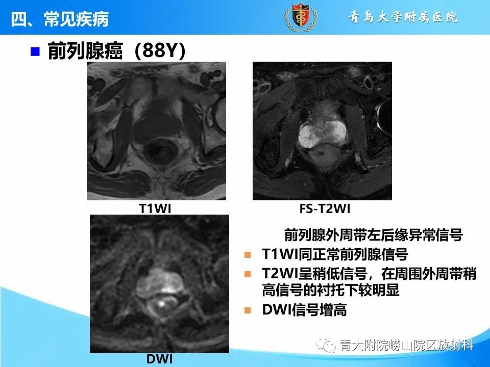影像PPT - 【PPT】前列腺MRI解剖分区-35