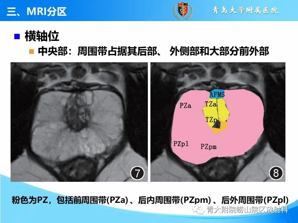 影像PPT - 【PPT】前列腺MRI解剖分区-19