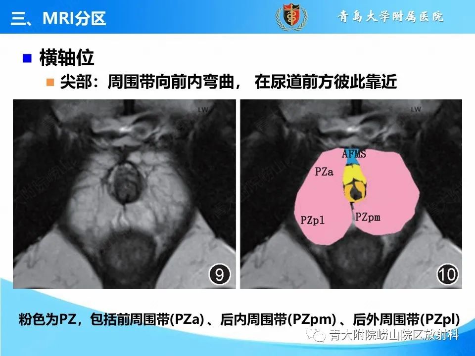 影像PPT - 【PPT】前列腺MRI解剖分区-20