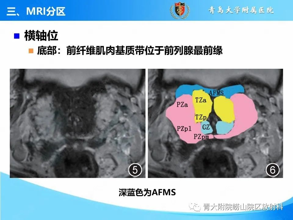 影像PPT - 【PPT】前列腺MRI解剖分区-23