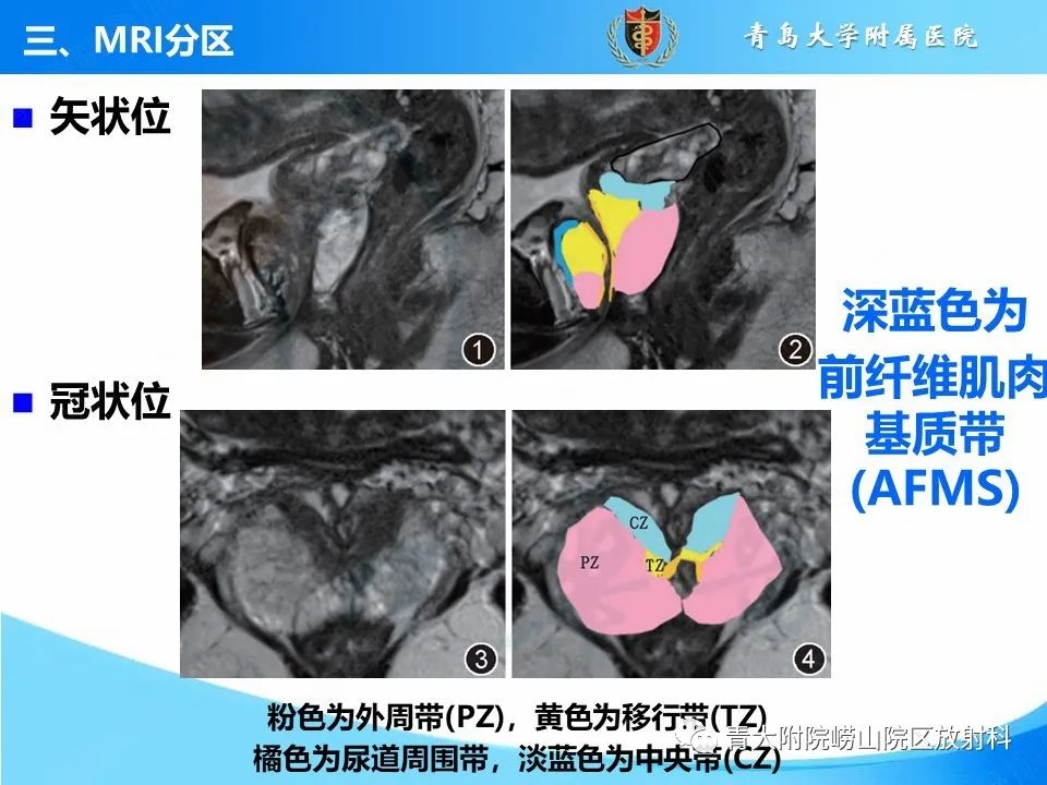 影像PPT - 【PPT】前列腺MRI解剖分区-4