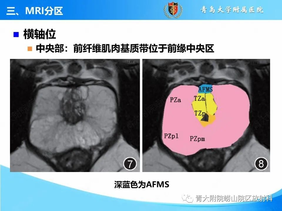 影像PPT - 【PPT】前列腺MRI解剖分区-5