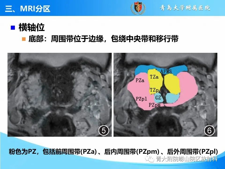 影像PPT - 【PPT】前列腺MRI解剖分区-3