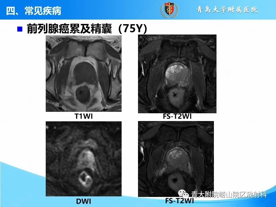 影像PPT - 【PPT】前列腺MRI解剖分区-9