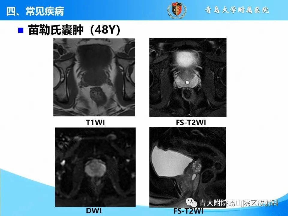 影像PPT - 【PPT】前列腺MRI解剖分区-8