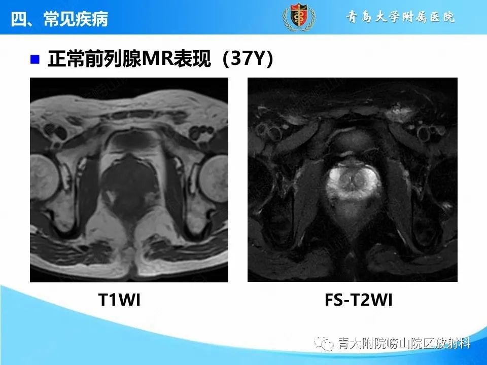 影像PPT - 【PPT】前列腺MRI解剖分区-6