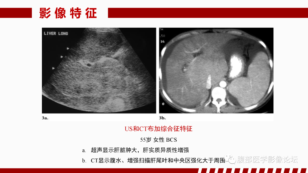 影像PPT - 【PPT】肝脏血管性病变影像学表现-16