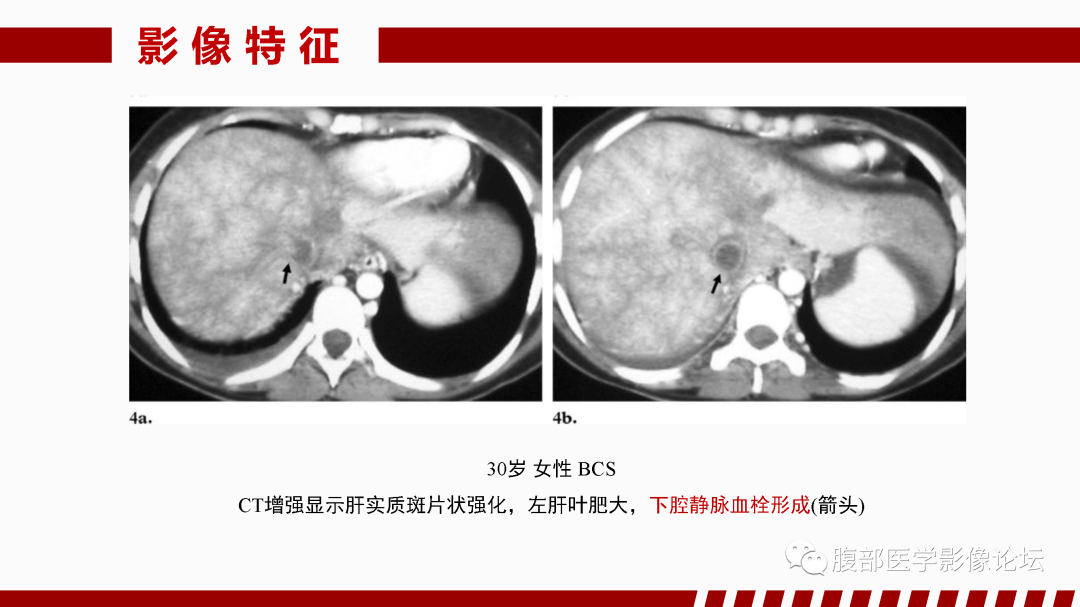 影像PPT - 【PPT】肝脏血管性病变影像学表现-15