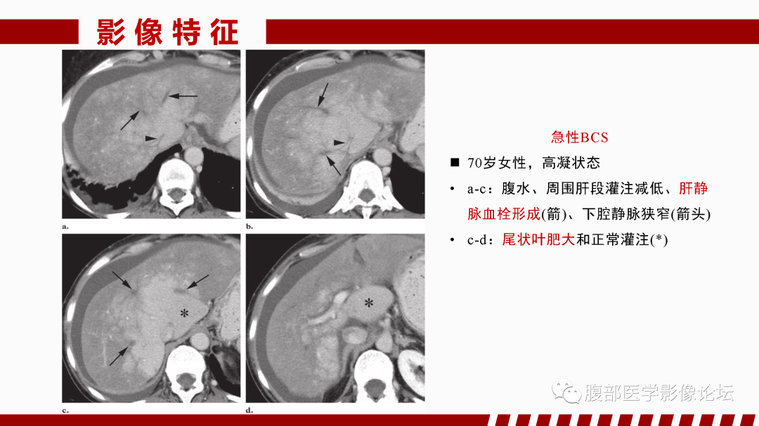 影像PPT - 【PPT】肝脏血管性病变影像学表现-17