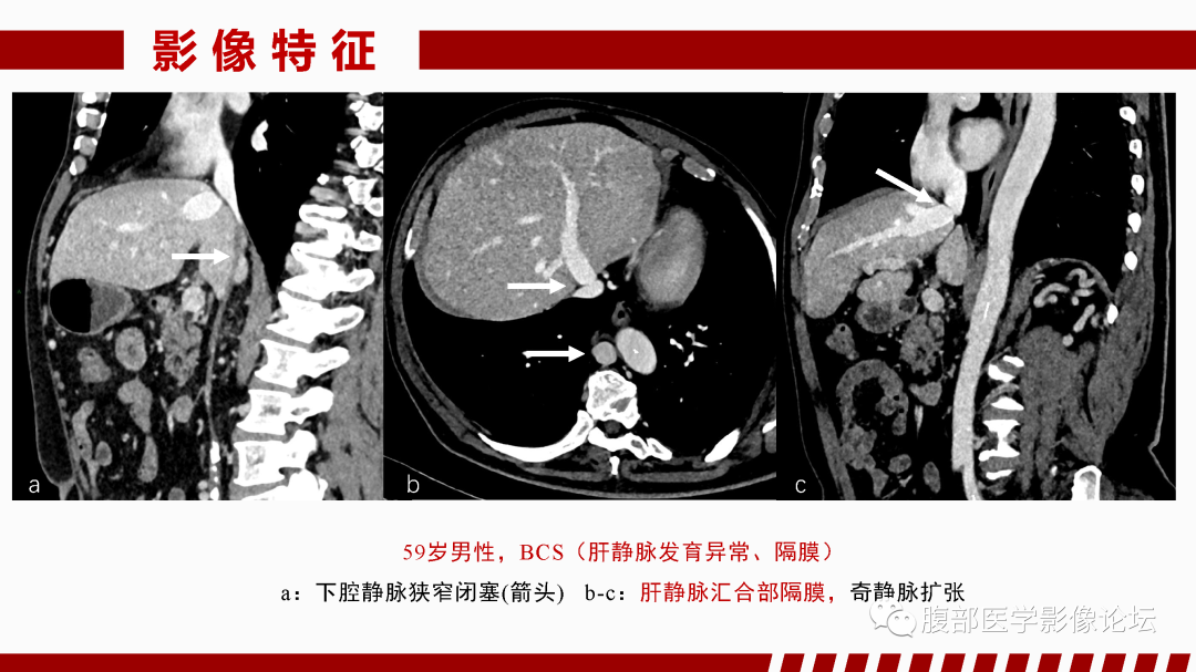影像PPT - 【PPT】肝脏血管性病变影像学表现-14