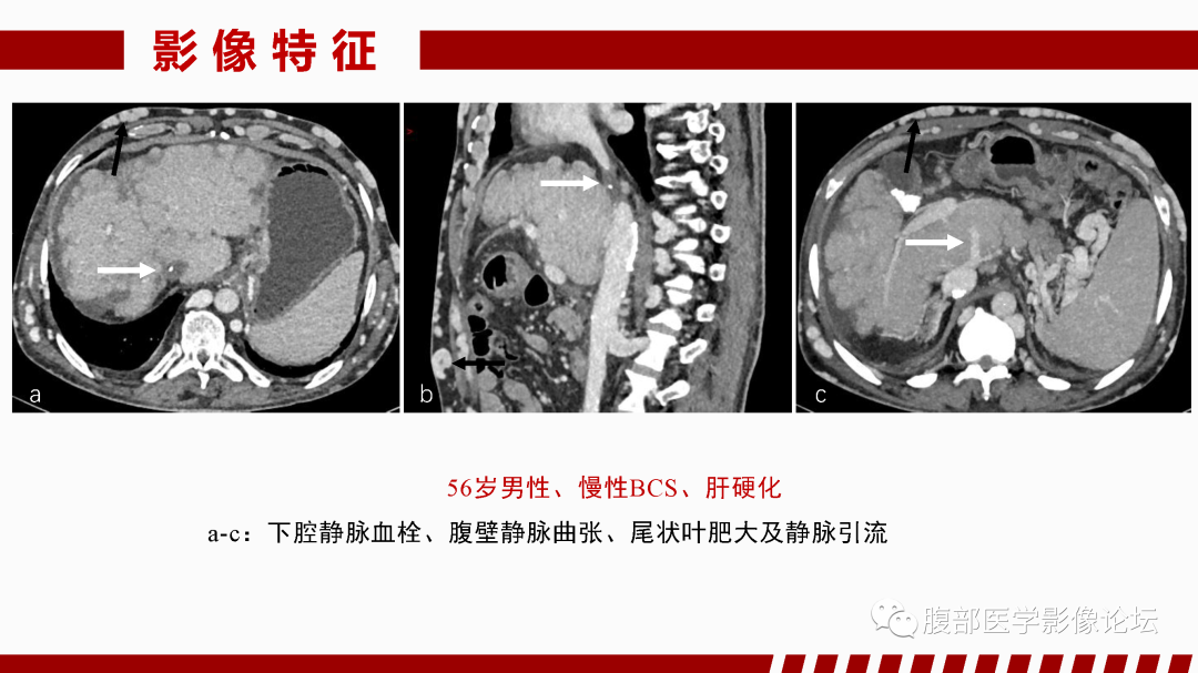 影像PPT - 【PPT】肝脏血管性病变影像学表现-20