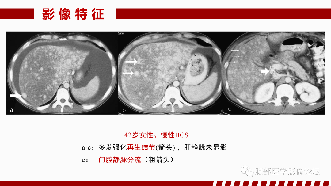 影像PPT - 【PPT】肝脏血管性病变影像学表现-19