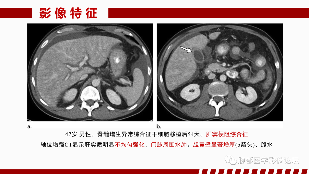 影像PPT - 【PPT】肝脏血管性病变影像学表现-23