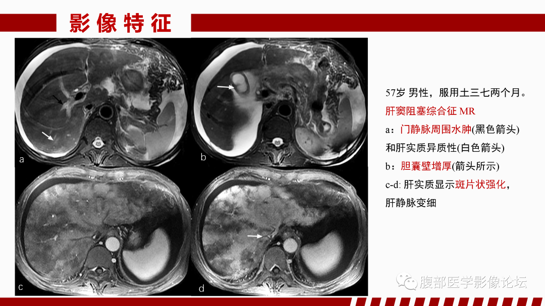 影像PPT - 【PPT】肝脏血管性病变影像学表现-25