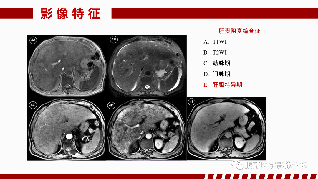 影像PPT - 【PPT】肝脏血管性病变影像学表现-27