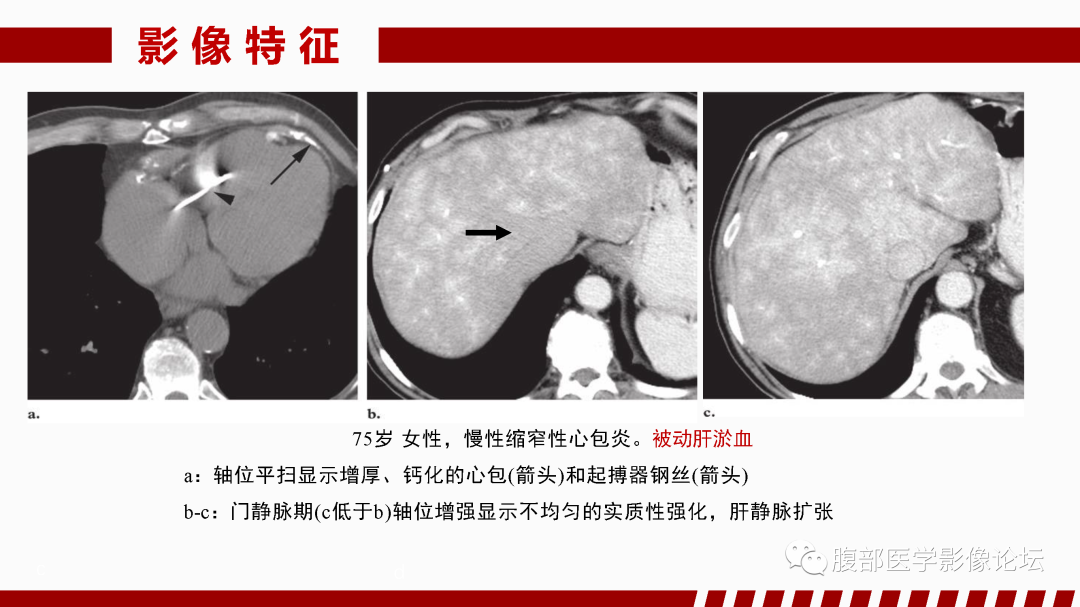 影像PPT - 【PPT】肝脏血管性病变影像学表现-31