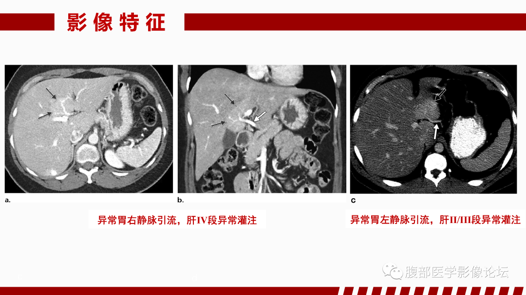 影像PPT - 【PPT】肝脏血管性病变影像学表现-34