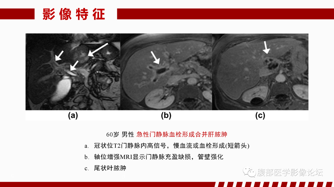 影像PPT - 【PPT】肝脏血管性病变影像学表现-41