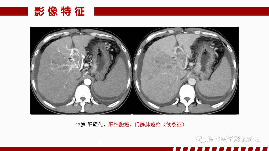影像PPT - 【PPT】肝脏血管性病变影像学表现-43