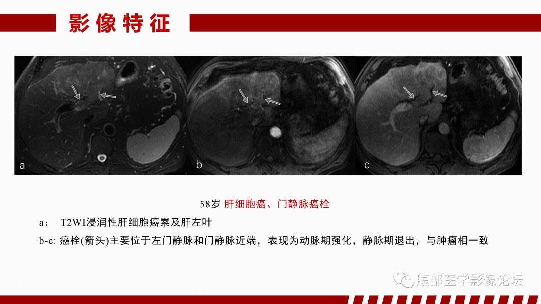 影像PPT - 【PPT】肝脏血管性病变影像学表现-42
