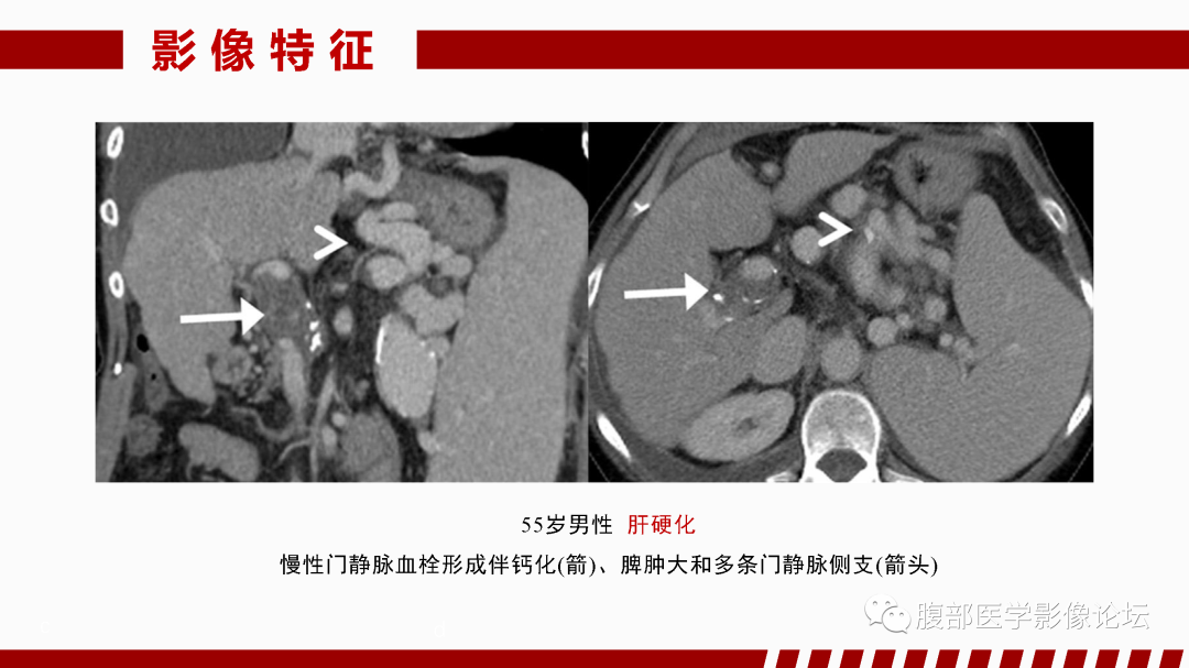影像PPT - 【PPT】肝脏血管性病变影像学表现-44