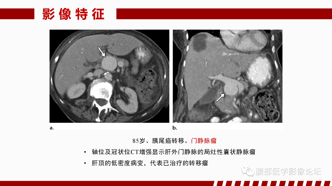 影像PPT - 【PPT】肝脏血管性病变影像学表现-51