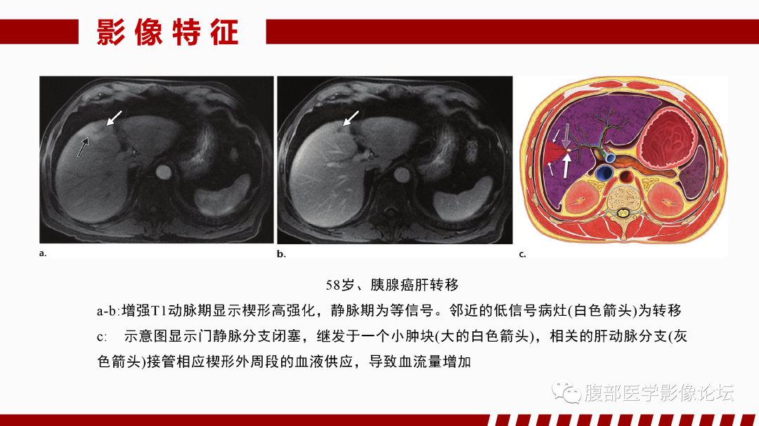 影像PPT - 【PPT】肝脏血管性病变影像学表现-49