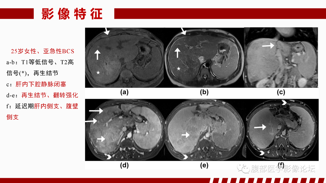影像PPT - 【PPT】肝脏血管性病变影像学表现-18