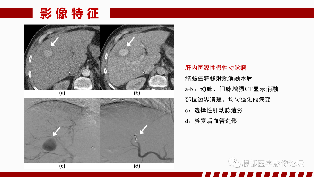 影像PPT - 【PPT】肝脏血管性病变影像学表现-60