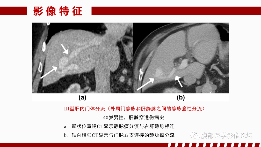 影像PPT - 【PPT】肝脏血管性病变影像学表现-69