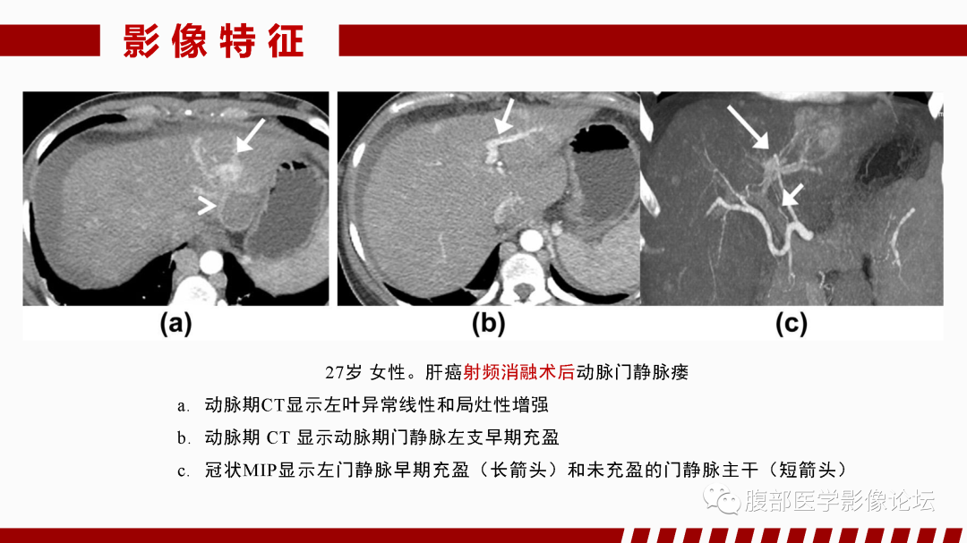 影像PPT - 【PPT】肝脏血管性病变影像学表现-64
