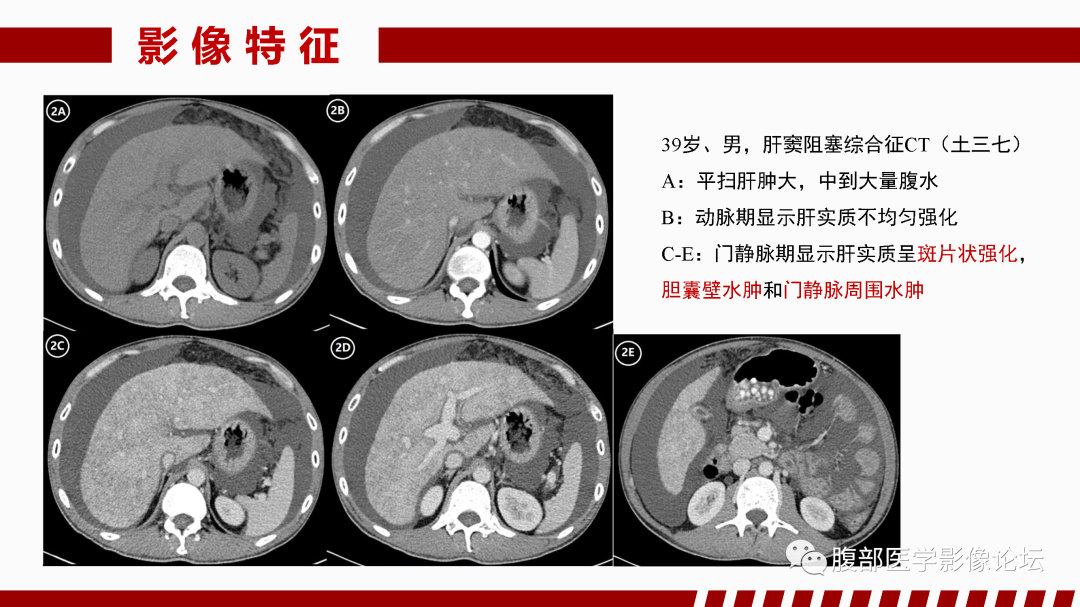 影像PPT - 【PPT】肝脏血管性病变影像学表现-24