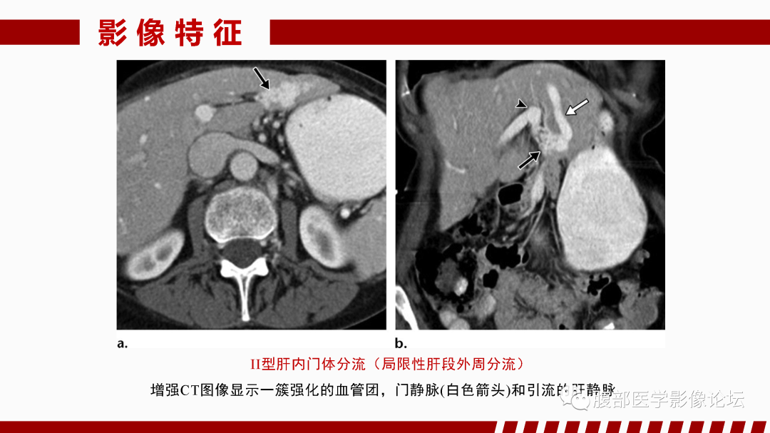 影像PPT - 【PPT】肝脏血管性病变影像学表现-68