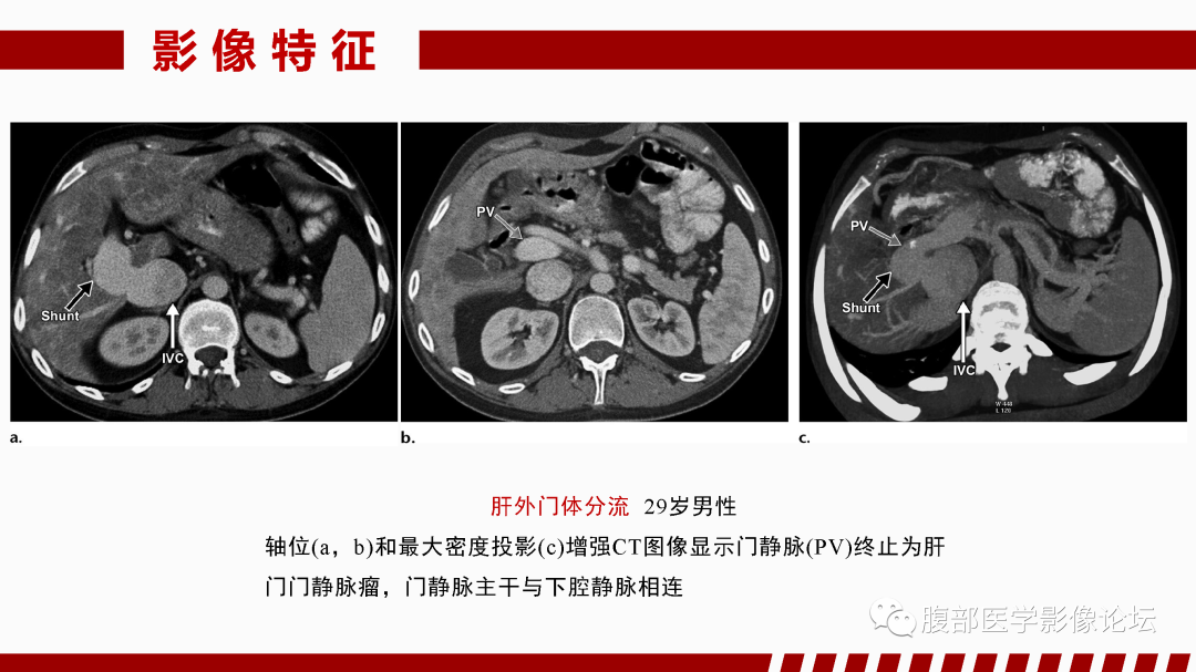 影像PPT - 【PPT】肝脏血管性病变影像学表现-71