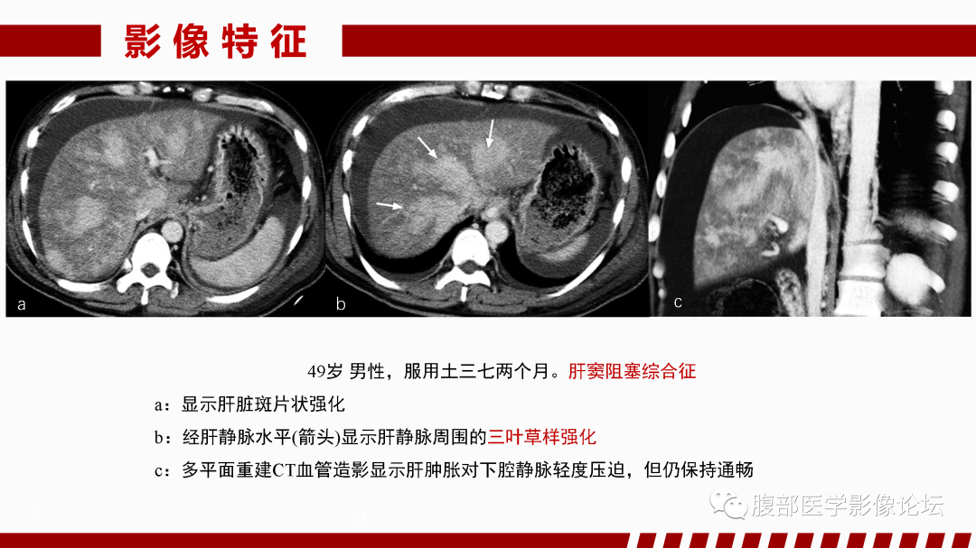 影像PPT - 【PPT】肝脏血管性病变影像学表现-26