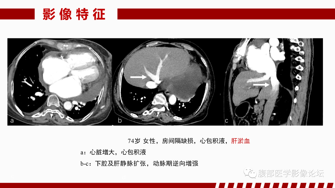 影像PPT - 【PPT】肝脏血管性病变影像学表现-32