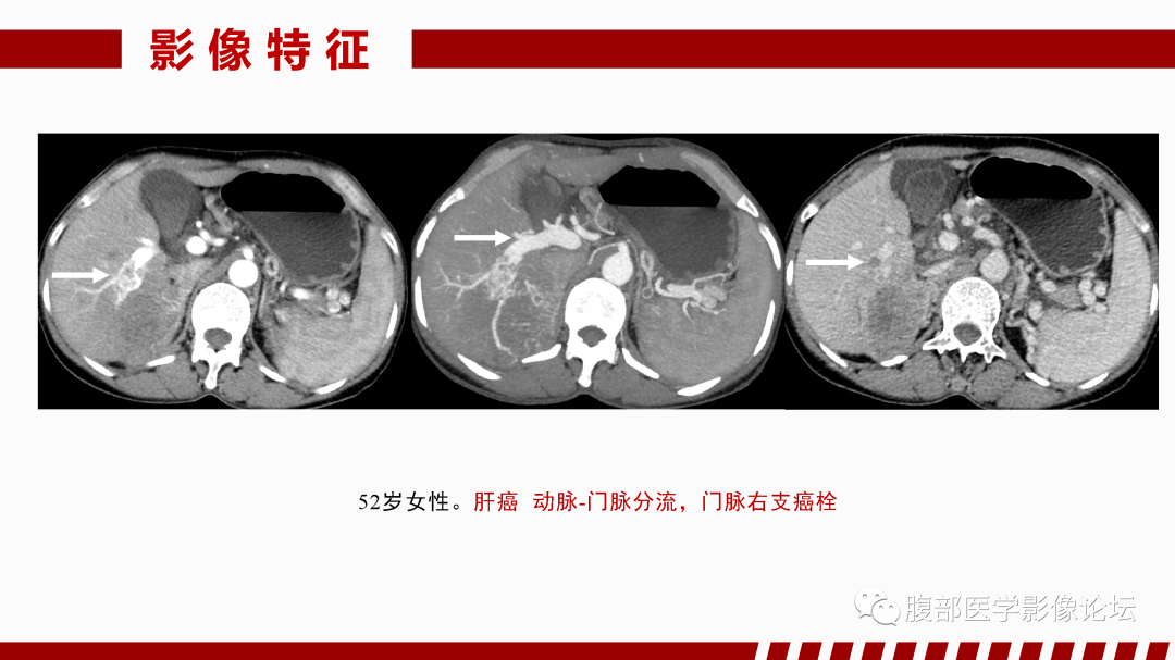 影像PPT - 【PPT】肝脏血管性病变影像学表现-66