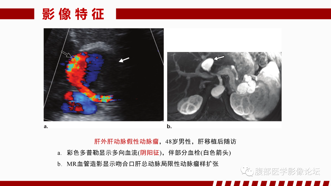 影像PPT - 【PPT】肝脏血管性病变影像学表现-61
