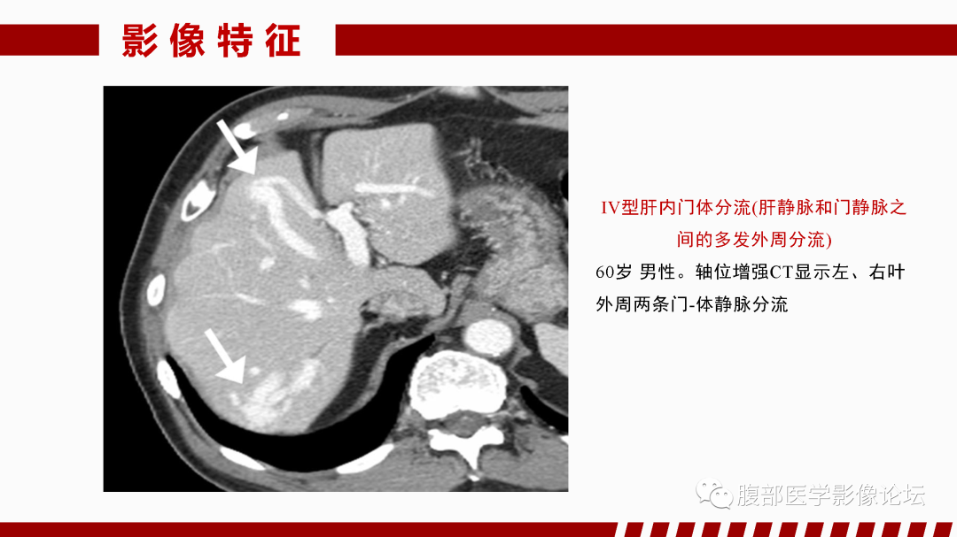 影像PPT - 【PPT】肝脏血管性病变影像学表现-70