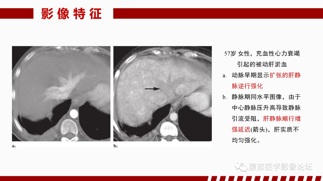 影像PPT - 【PPT】肝脏血管性病变影像学表现-30