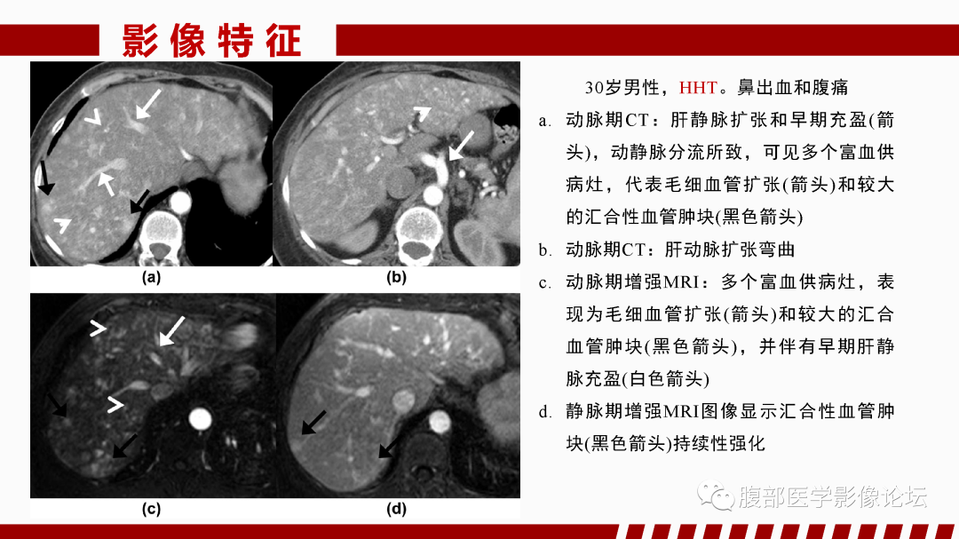 影像PPT - 【PPT】肝脏血管性病变影像学表现-80