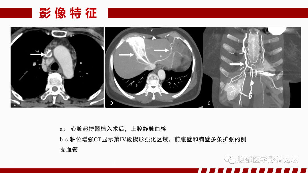 影像PPT - 【PPT】肝脏血管性病变影像学表现-37