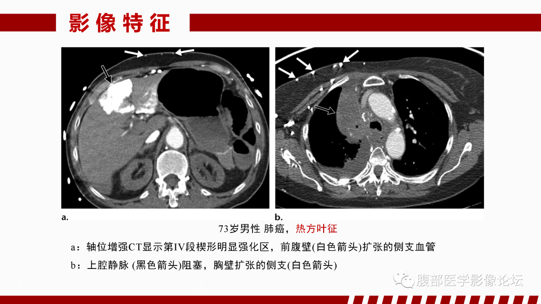 影像PPT - 【PPT】肝脏血管性病变影像学表现-36
