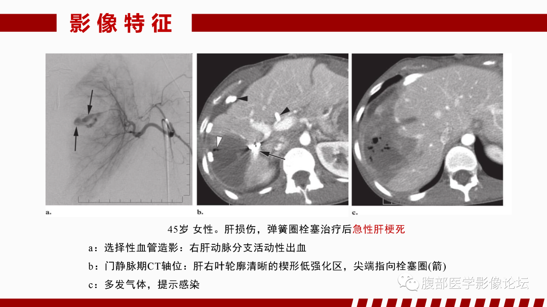 影像PPT - 【PPT】肝脏血管性病变影像学表现-56